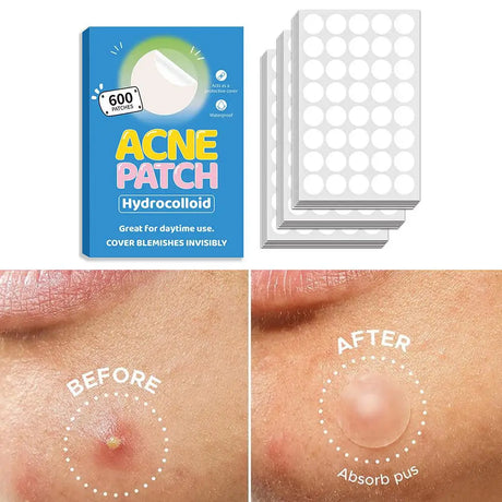 Crescent-shaped Acne Patches Invisible Pimple Cover For Face Oil Control Spot Treatment Sticker For Covering Zits And Blemishes