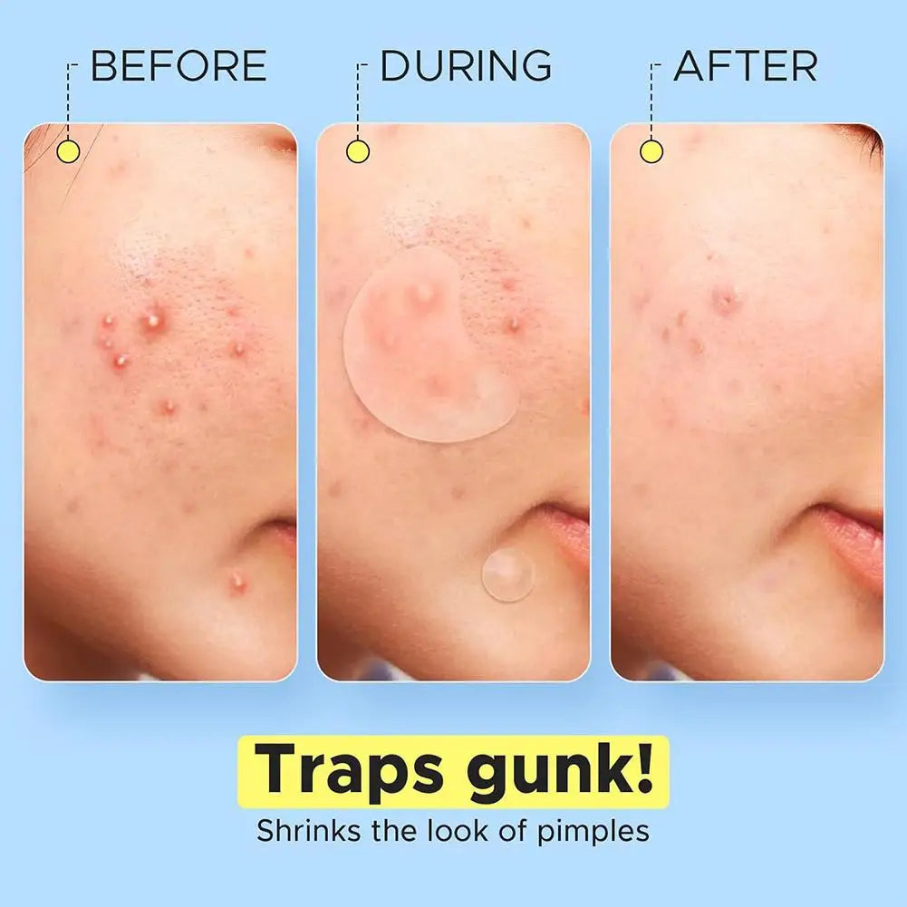 Crescent-shaped Acne Patches Invisible Pimple Cover For Face Oil Control Spot Treatment Sticker For Covering Zits And Blemishes