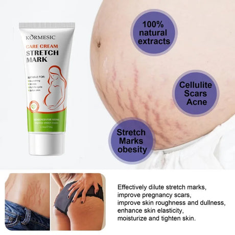 Remove Pregnancy Stretch Marks Cream Improves Elasticity Fade Growth Lines Smoothing Nourishing Moisturizing Firming Skin Care