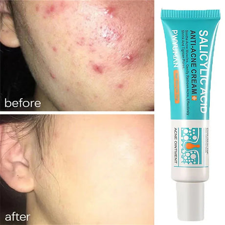 Salicylic Acid Acne Treatment Cream Repair Pimple Spots Deep Cleaning Pore Shrinking Anti-acne Oil Control Moisturizer Skin Care