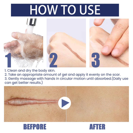 EELHOE Silicone Skin Scar Gel Retinol Niacinamide Scars Stretch Marks Burn Marks Deeply Nourish Skin Reduce Redness Swelling 30g