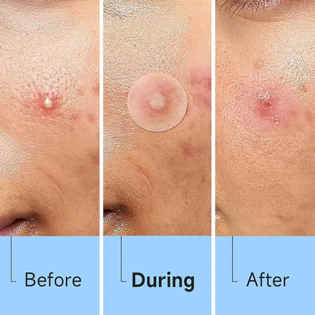 Crescent-shaped Acne Patches Invisible Pimple Cover For Face Oil Control Spot Treatment Sticker For Covering Zits And Blemishes