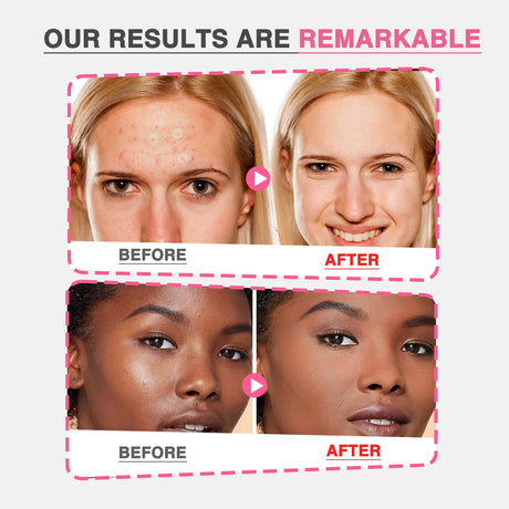 GROEI 18Pcs Microneedle Acne Patches Pimple Invisible Beauty Concealer Blemish Treatment Deep Clean Pores Overnight Recovery