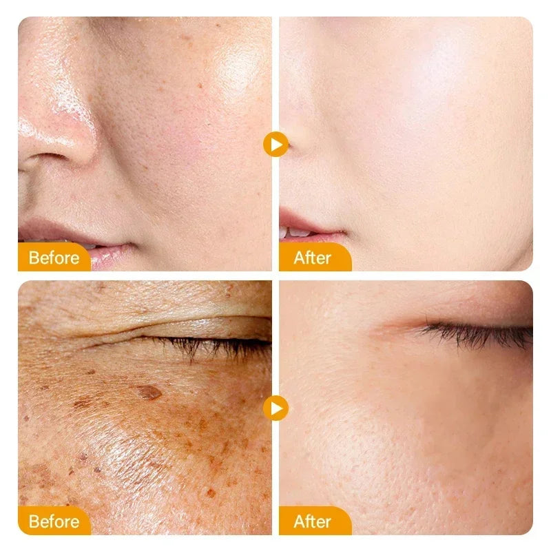 Dark Spots Remover Whitening Face Set Freckle Melanin Correcting Reduce Fine Lines Brighten Essence Korean Beauty Skin Care 