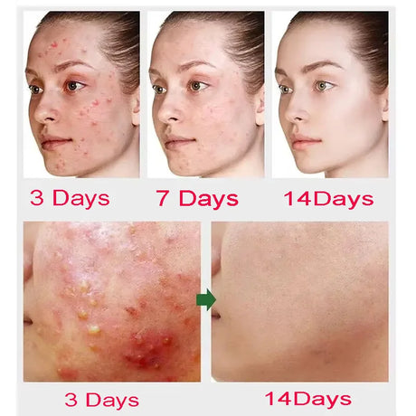 Salicylic Acid Acne Treatment Cream Repair Pimple Spots Deep Cleaning Pore Shrinking Anti-acne Oil Control Moisturizer Skin Care
