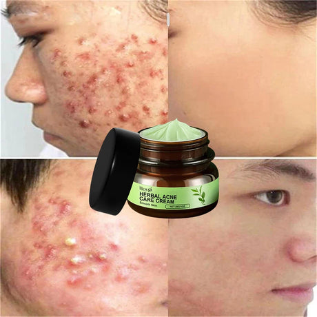 Natural Herbs Acid Acne Cream Shrink Pores Blackheads Scars Acne Marks Blemishes Oil Control Whitening Korean Skin Care Products