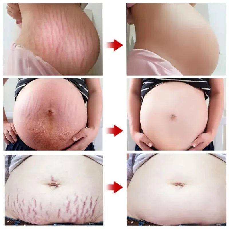 Stretch Marks Repair Cream Fade Lines Improve Duliness Tightness Long-lasting Moisturizing Smooth Enhance Elasticity Body Care