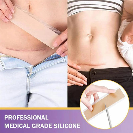 Surgical Soft Silicone Gel Scar Sheet Patch Treatmen Removal Tape Acne Trauma Burn Scar Cover Skin Repair Section Ear Beauty