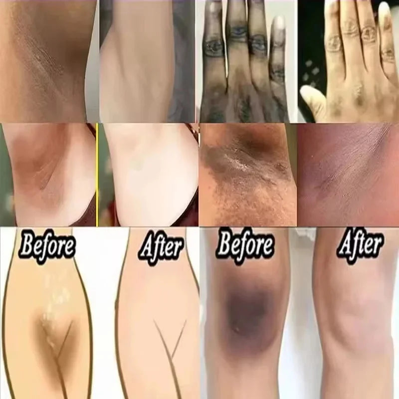 Whitening Cream For Dark Skin Underarm Bleaching Armpit Lightening And Intimate Area Woman Moisturizer Korean Skin Care Products