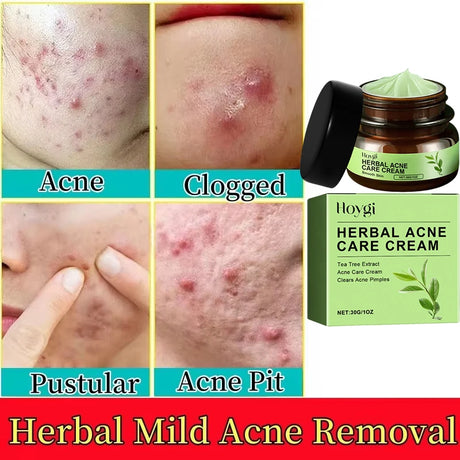 Natural Herbs Acid Acne Cream Shrink Pores Blackheads Scars Acne Marks Blemishes Oil Control Whitening Korean Skin Care Products