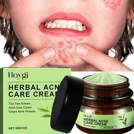 Natural Herbs Acid Acne Cream Shrink Pores Blackheads Scars Acne Marks Blemishes Oil Control Whitening Korean Skin Care Products