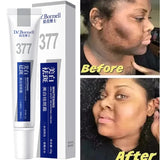 Powerful Spot-Removing Whiten Cream Brighten Skin Fast Eliminates Melanin Pigmentation Melasma Dark Spots Korean Face Skin Care