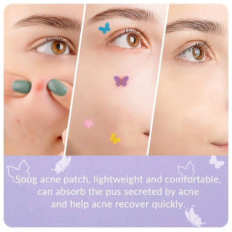 120 Counts Cute Colorful Butterfly Pimple Patches Acne Treatment Stickers Invisible Acne Cover Face Spot Pimple Patch Skin Care