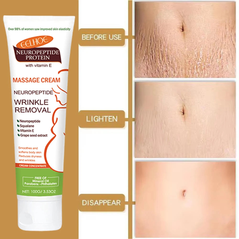 100g Stretch Marks Permanent Removal Cream Maternity Pregnant Women Pregnancy Anti-Winkle Smooth Repair Firming Skin Body Care