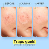 Crescent-shaped Acne Patches Invisible Pimple Cover For Face Oil Control Spot Treatment Sticker For Covering Zits And Blemishes