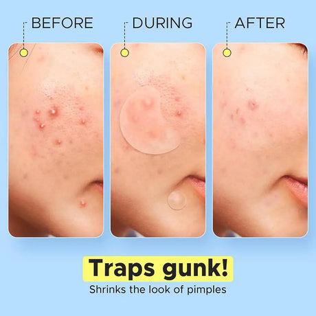 Crescent-shaped Acne Patches Invisible Pimple Cover For Face Oil Control Spot Treatment Sticker For Covering Zits And Blemishes