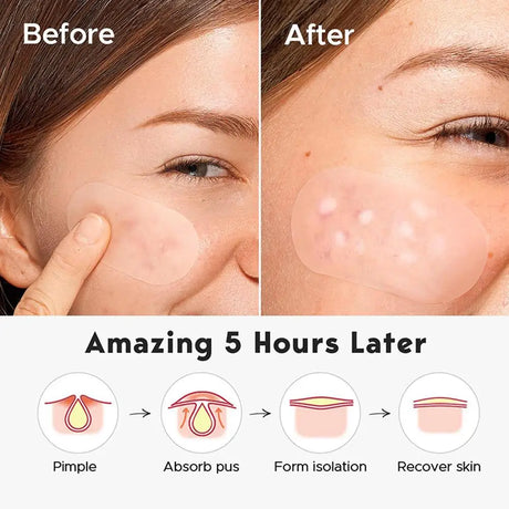 Crescent-shaped Acne Patches Invisible Pimple Cover For Face Oil Control Spot Treatment Sticker For Covering Zits And Blemishes