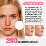 GROEI 18Pcs Microneedle Acne Patches Pimple Invisible Beauty Concealer Blemish Treatment Deep Clean Pores Overnight Recovery