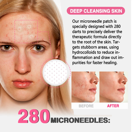 GROEI 18Pcs Microneedle Acne Patches Pimple Invisible Beauty Concealer Blemish Treatment Deep Clean Pores Overnight Recovery