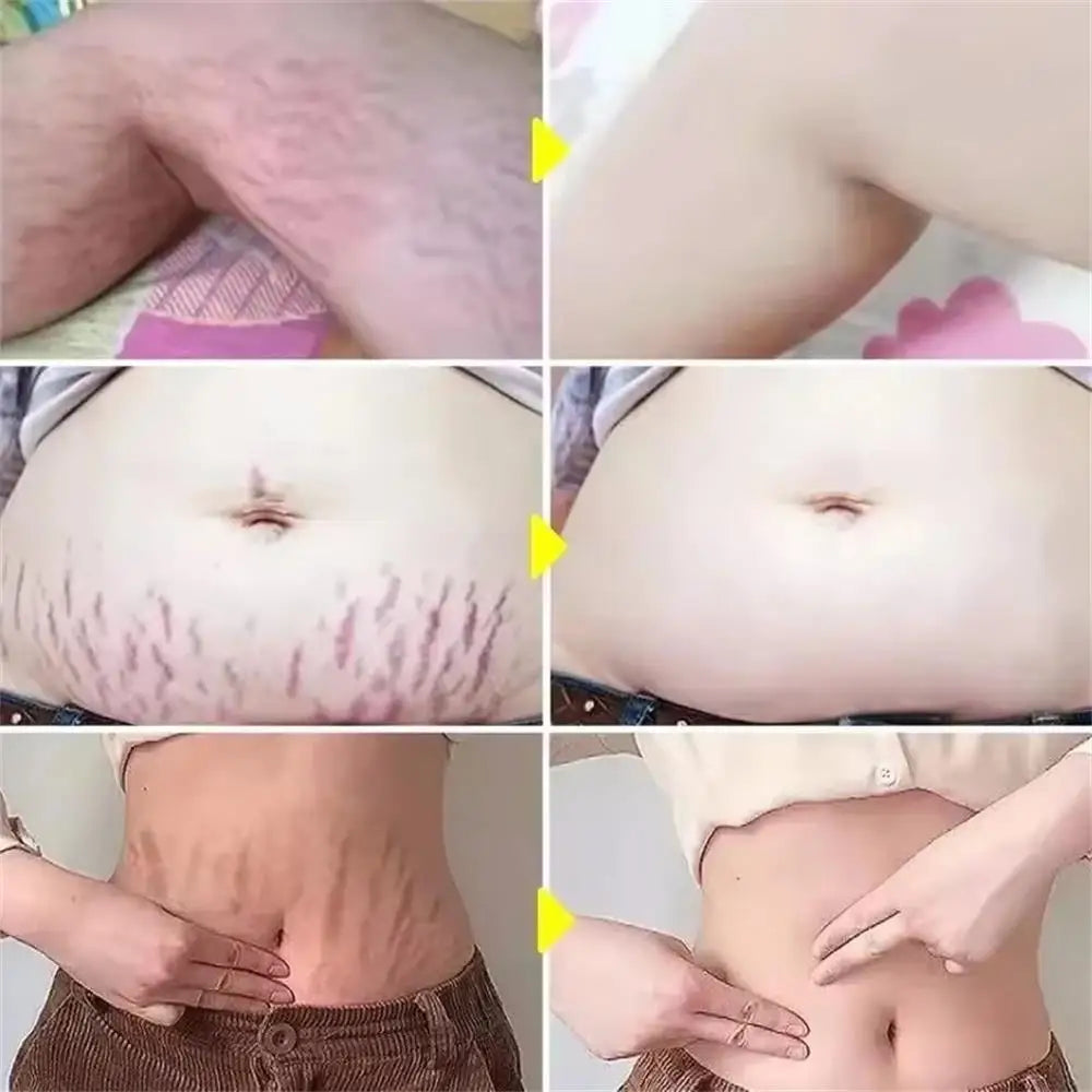 100g Stretch Marks Permanent Removal Cream Maternity Pregnant Women Pregnancy Anti-Winkle Smooth Repair Firming Skin Body Care