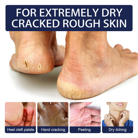 Anti Crack Cream Heel Chapping Repair Dead Skin Removal Anti-Drying Hand Treatment Nourishing Foot Dryness Cracked Repair Cream