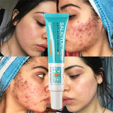 Salicylic Acid Acne Treatment Cream Repair Pimple Spots Deep Cleaning Pore Shrinking Anti-acne Oil Control Moisturizer Skin Care