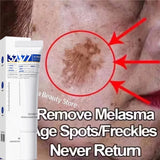 Powerful Spot-Removing Whiten Cream Brighten Skin Fast Eliminates Melanin Pigmentation Melasma Dark Spots Korean Face Skin Care