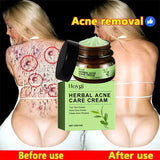 Natural Herbs Acid Acne Cream Shrink Pores Blackheads Scars Acne Marks Blemishes Oil Control Whitening Korean Skin Care Products
