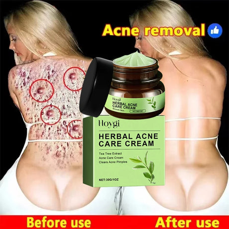 Natural Herbs Acid Acne Cream Shrink Pores Blackheads Scars Acne Marks Blemishes Oil Control Whitening Korean Skin Care Products