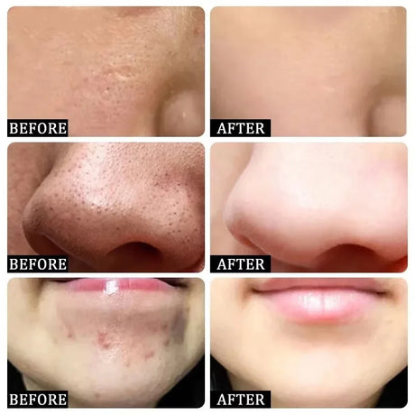 Feels Like Silk, Looks Like Filter. Salicylic Acid Pore Serum – Tightens, Minimizes, Firms, Smooths Enlarged Pores – Korean