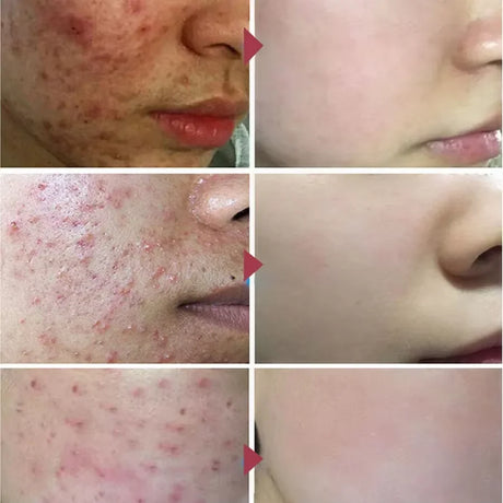 Salicylic Acid Acne Treatment Cream Repair Pimple Spots Deep Cleaning Pore Shrinking Anti-acne Oil Control Moisturizer Skin Care