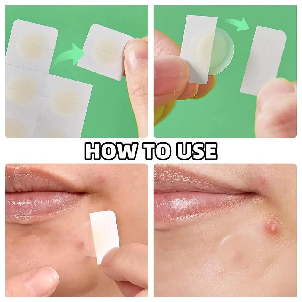 24PCS Microneedle AcnePatch Painlessly Penetrate Acne Patches Blemishes Pimples Covering Patch Daily Unisex Skincare