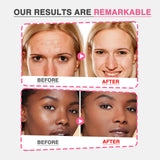 GROEI 18Pcs Microneedle Acne Patches Pimple Invisible Beauty Concealer Blemish Treatment Deep Clean Pores Overnight Recovery