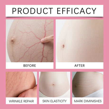 Pregnancy Belly Stretch Mark Cream for Elasticity Caffeine & Arnica Body Moisturizer Soothing Itchy Dry Skin Care for Moms to Be