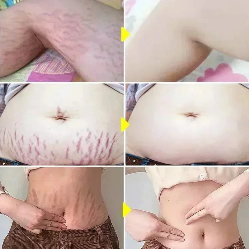 Maternity Stretch Mark Permanent Removal cream Brighten Anti-Winkle Smooth Repair Firming Restore Skin Elasticity Body Skin Care