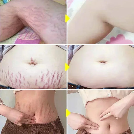 Maternity Stretch Mark Permanent Removal cream Brighten Anti-Winkle Smooth Repair Firming Restore Skin Elasticity Body Skin Care