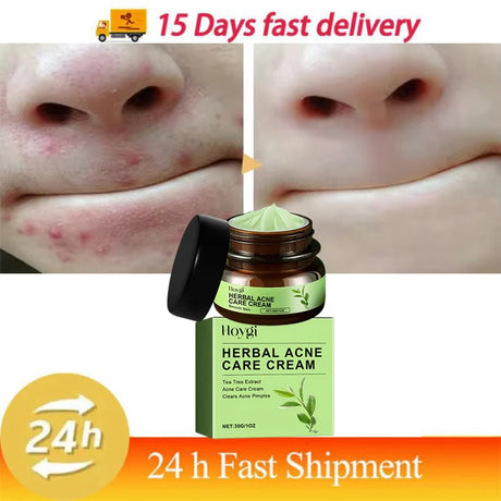 Natural Herbs Acid Acne Cream Shrink Pores Blackheads Scars Acne Marks Blemishes Oil Control Whitening Korean Skin Care Products